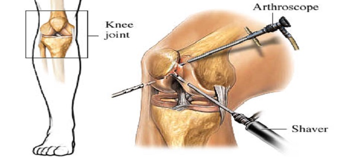 Arthroscopy Discharge Instructions