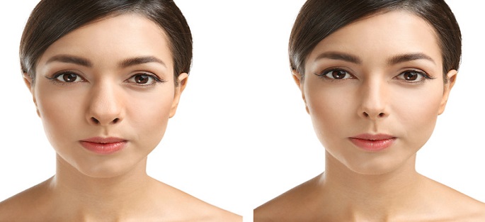 Rhinoplasty